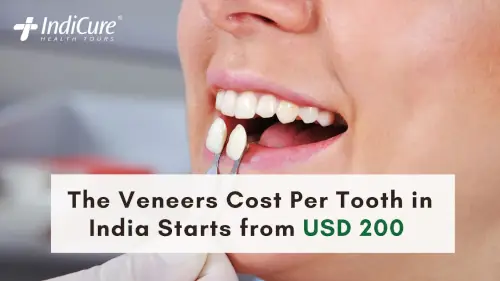 Veneers Cost in India Veneers Cost in India